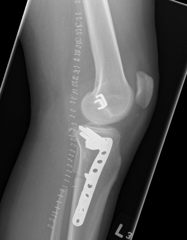 Chondrosarcoma Resection